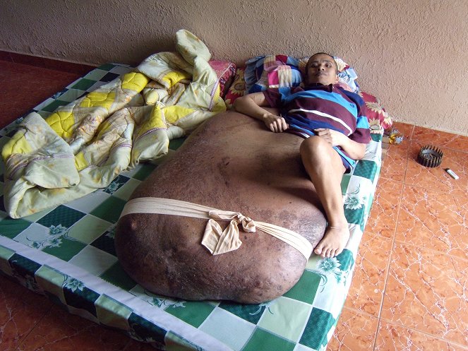 The Man with the 200lb Tumor - Do filme