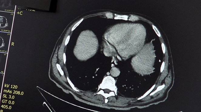 Příběhy moderní medicíny - Pravá polycytémie - Filmfotos