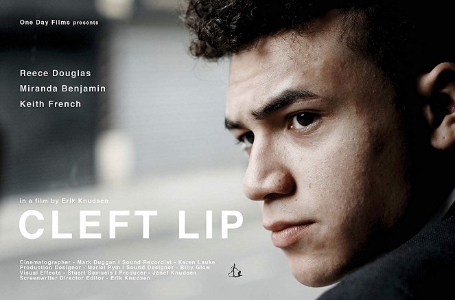 Cleft Lip - Carteles